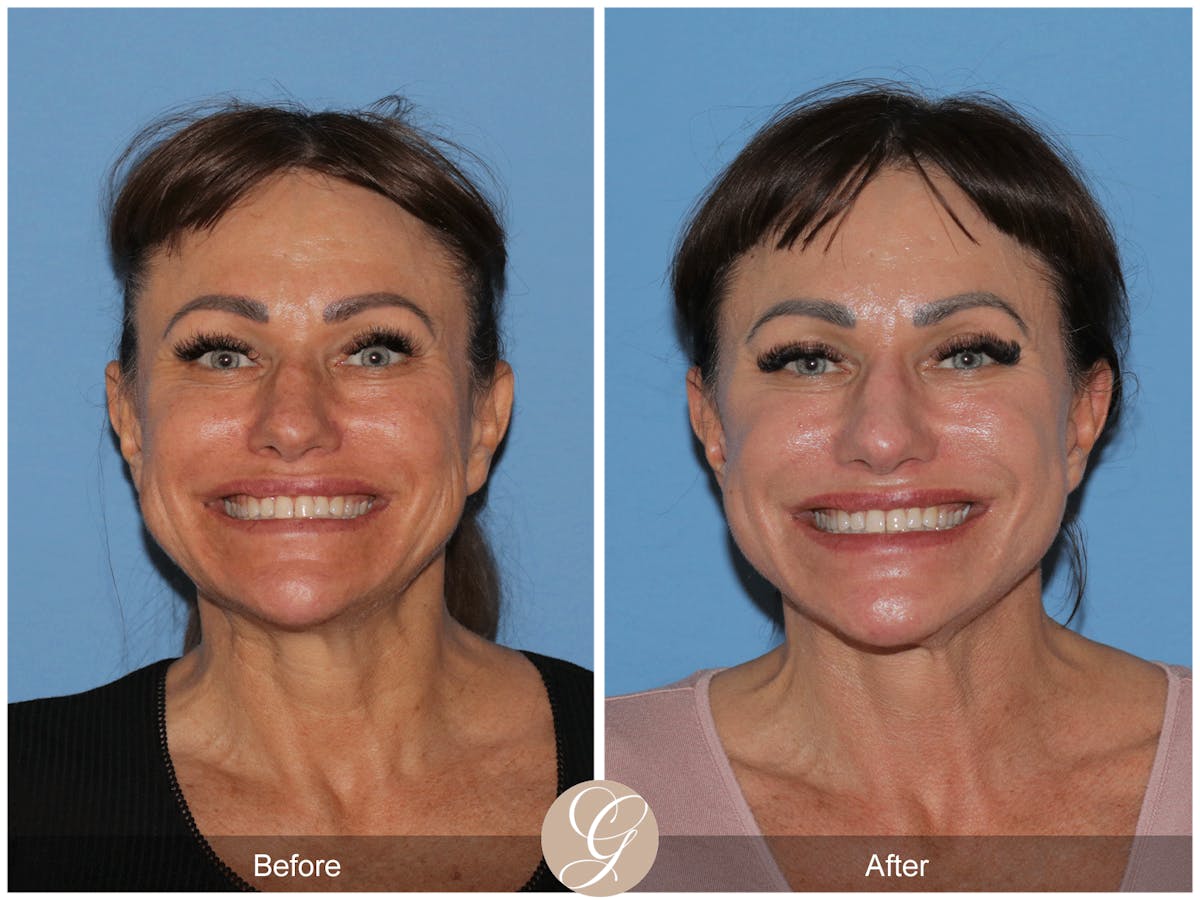 Preservation Facelift Before & After Gallery - Patient 164117 - Image 9