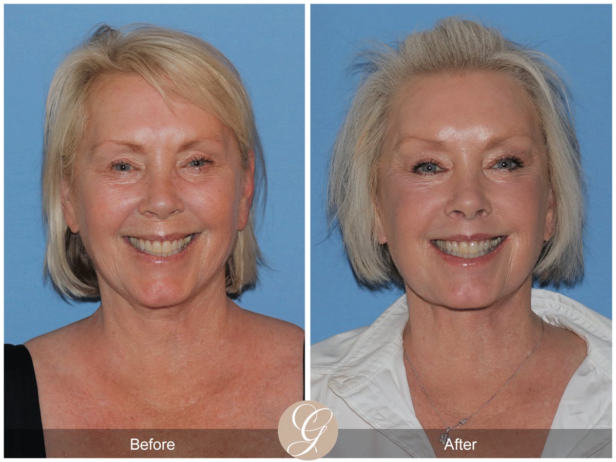 Preservation Facelift Before & After Gallery - Patient 189291 - Image 11