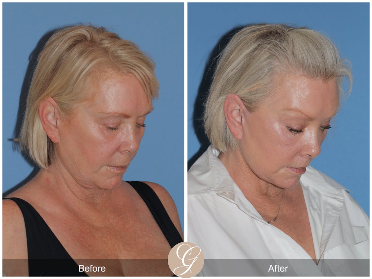 Preservation Facelift Before & After Gallery - Patient 189291 - Image 8