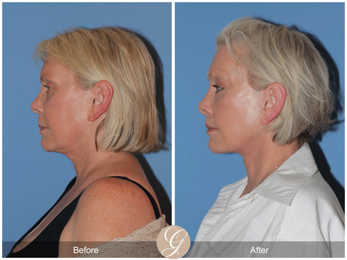 Preservation Facelift Before & After Gallery - Patient 189291 - Image 9