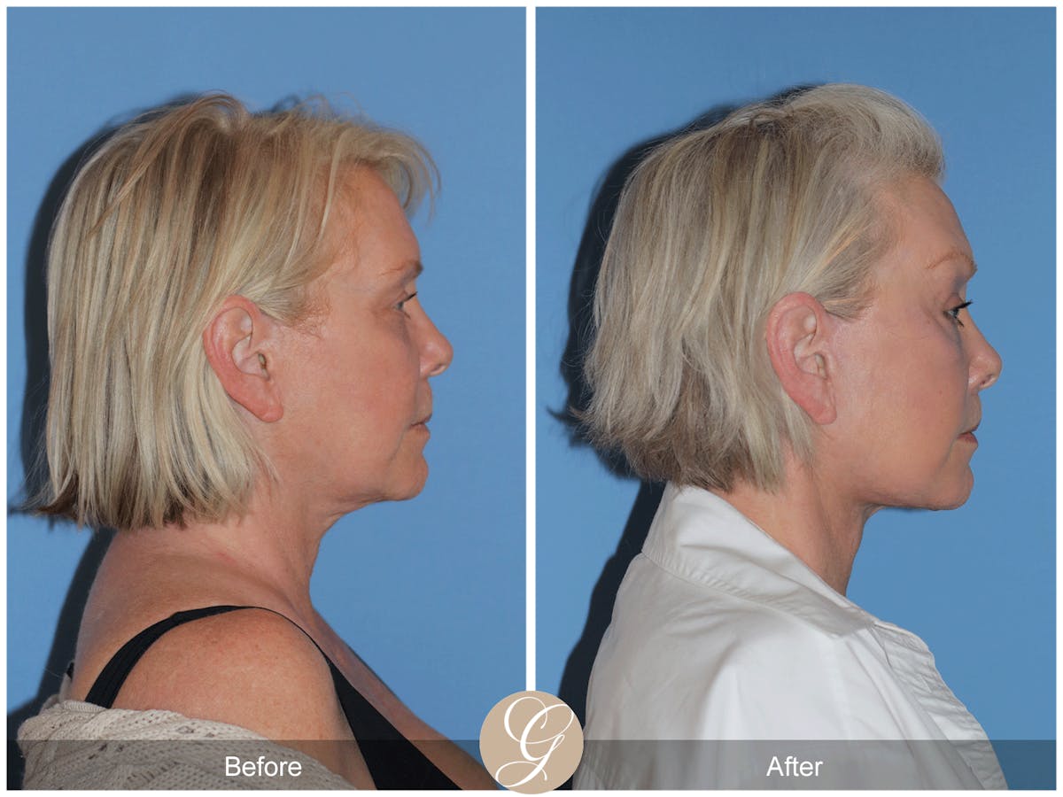 Preservation Facelift Before & After Gallery - Patient 189291 - Image 7