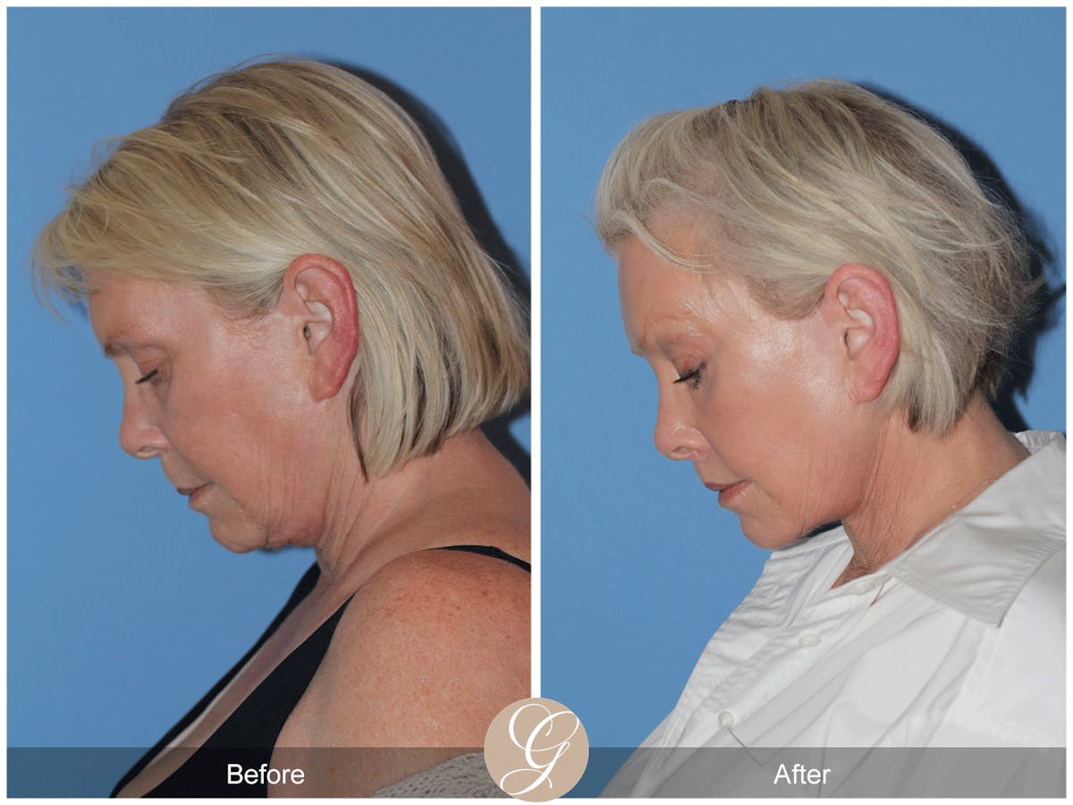 Preservation Facelift Before & After Gallery - Patient 189291 - Image 10