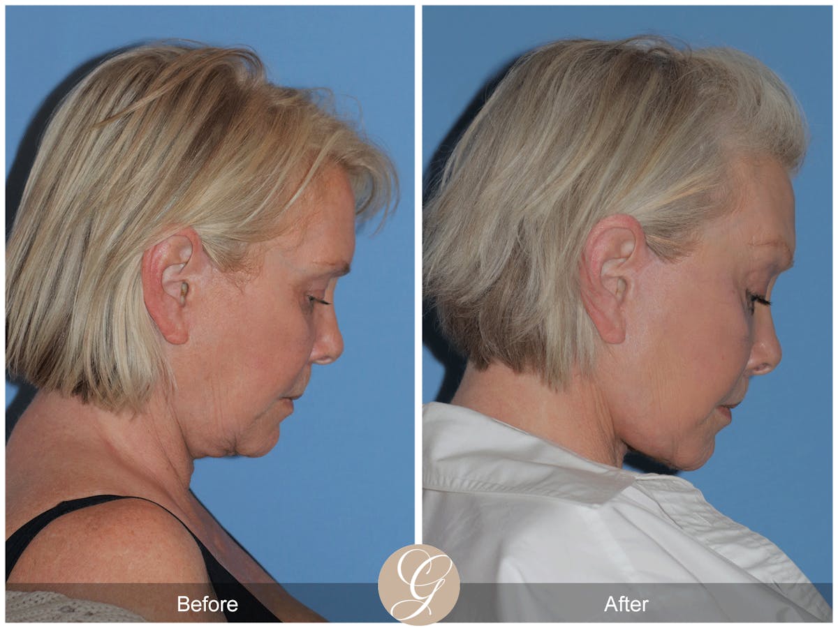 Preservation Facelift Before & After Gallery - Patient 189291 - Image 6