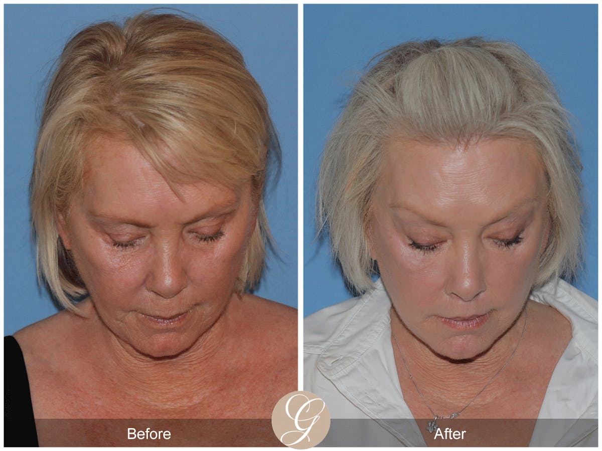 Preservation Facelift Before & After Gallery - Patient 189291 - Image 4
