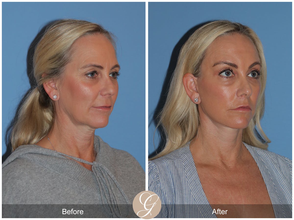 Preservation Facelift Before & After Gallery - Patient 136365 - Image 2