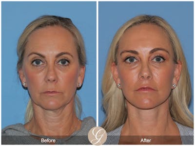 Preservation Facelift Before & After Gallery - Patient 136365 - Image 1