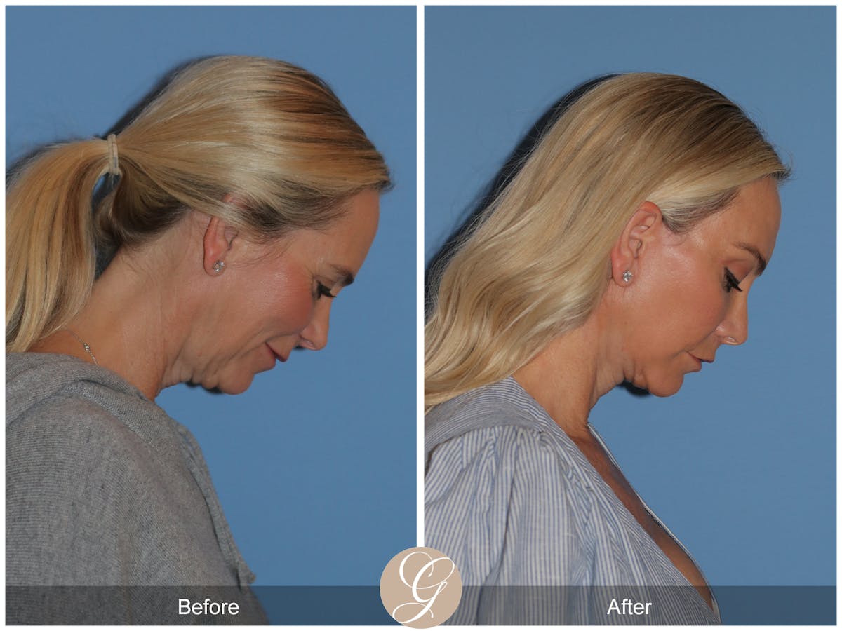 Preservation Facelift Before & After Gallery - Patient 136365 - Image 4