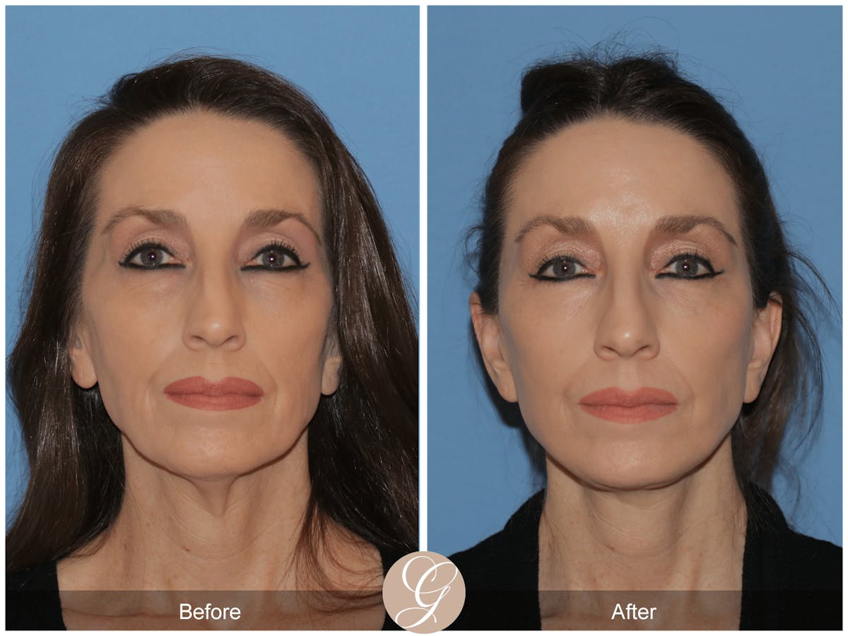 Preservation Facelift Before & After Gallery - Patient 170839 - Image 1