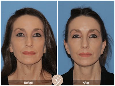 Deep Plane Facelift Before & After Gallery - Patient 785671 - Image 1