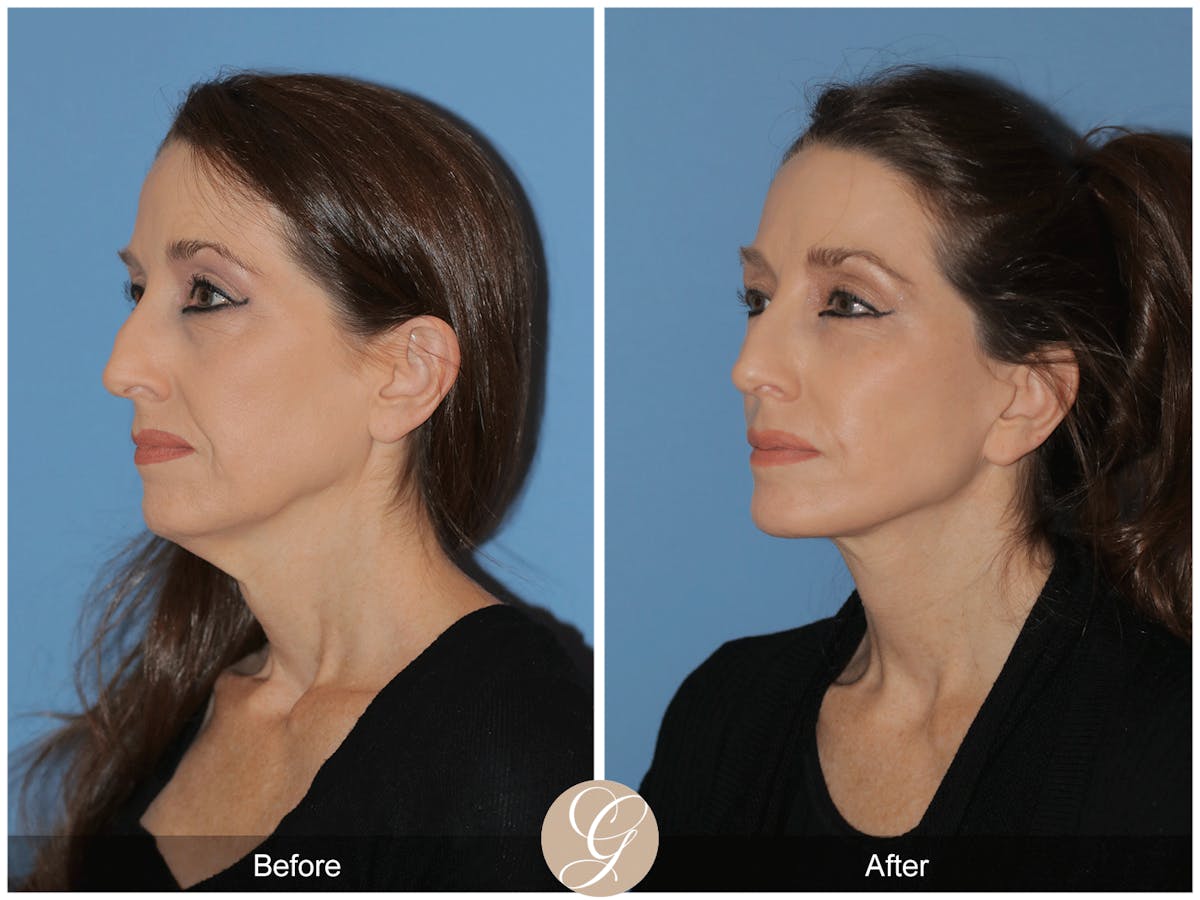 Preservation Facelift Before & After Gallery - Patient 170839 - Image 2