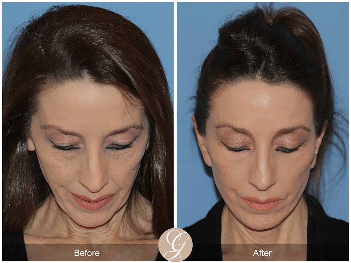 Preservation Facelift Before & After Gallery - Patient 170839 - Image 4
