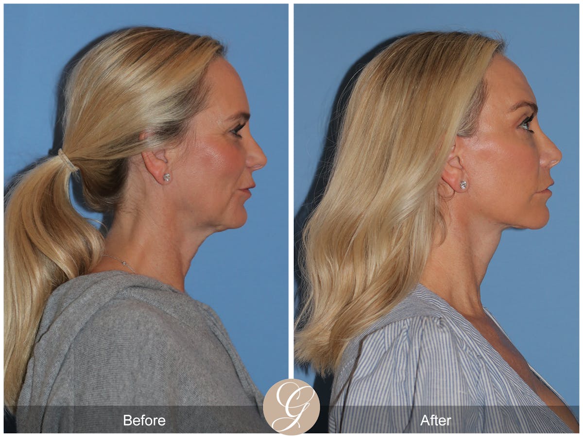 Preservation Facelift Before & After Gallery - Patient 136365 - Image 5