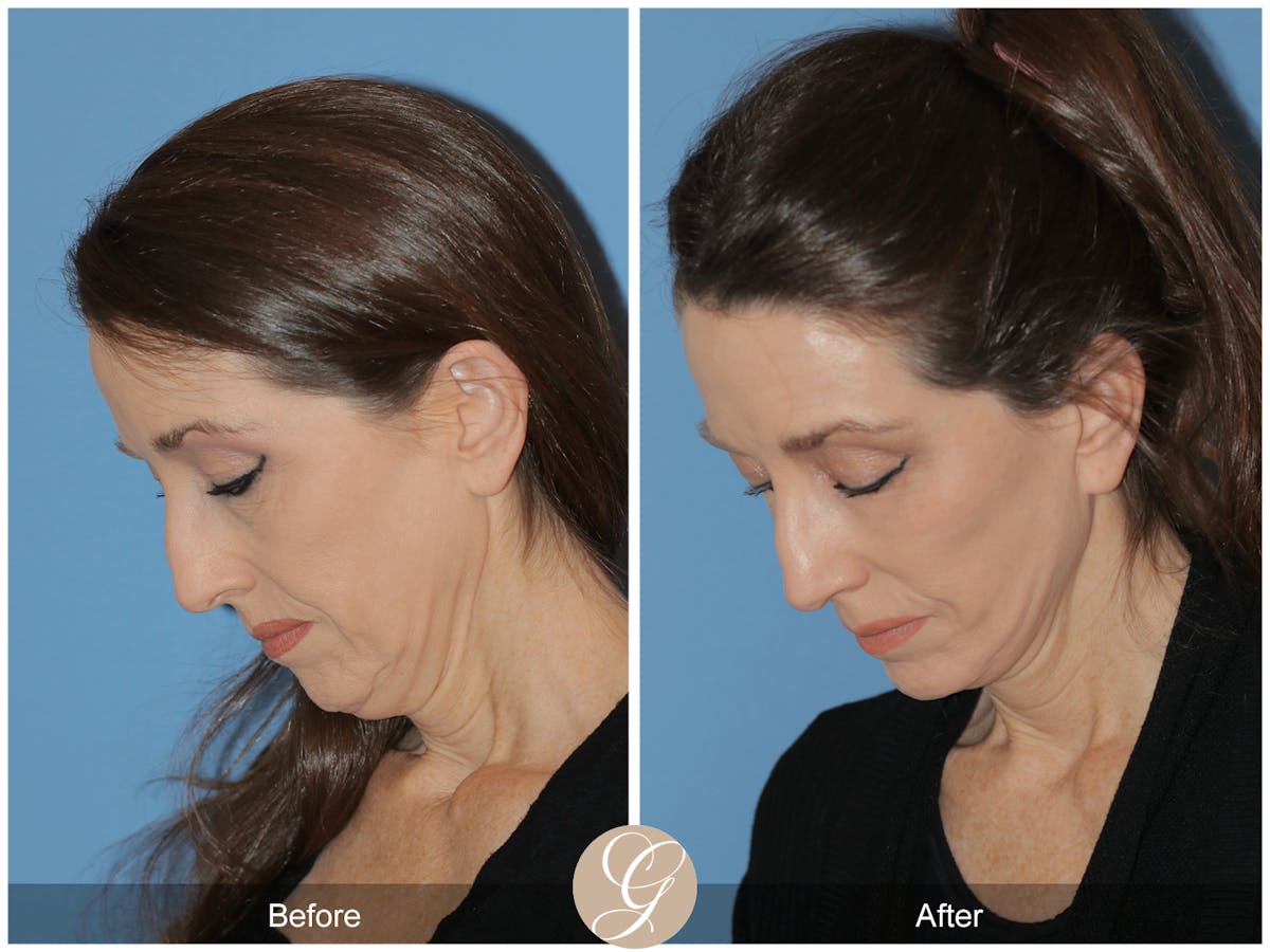 Preservation Facelift Before & After Gallery - Patient 170839 - Image 3