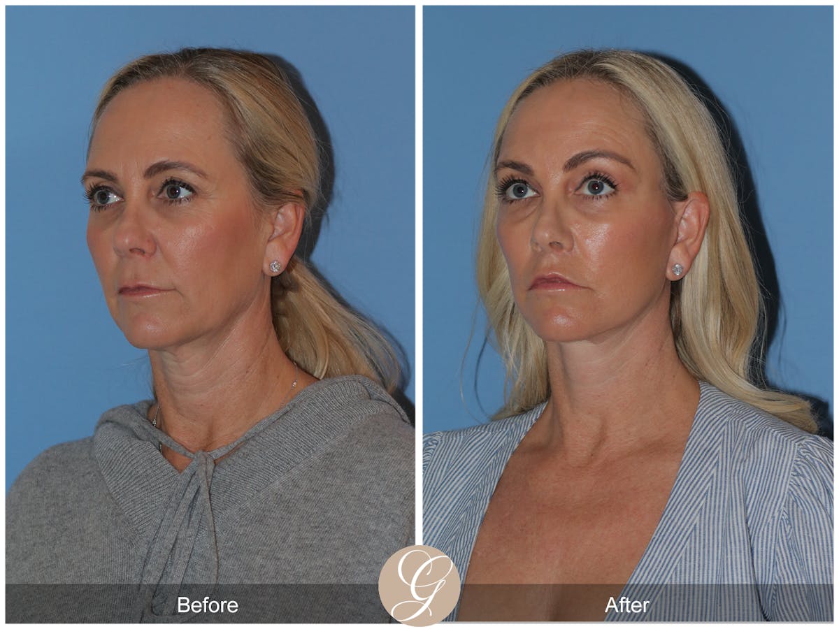 Preservation Facelift Before & After Gallery - Patient 136365 - Image 3