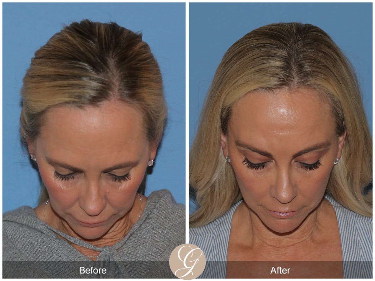 Preservation Facelift Before & After Gallery - Patient 136365 - Image 8