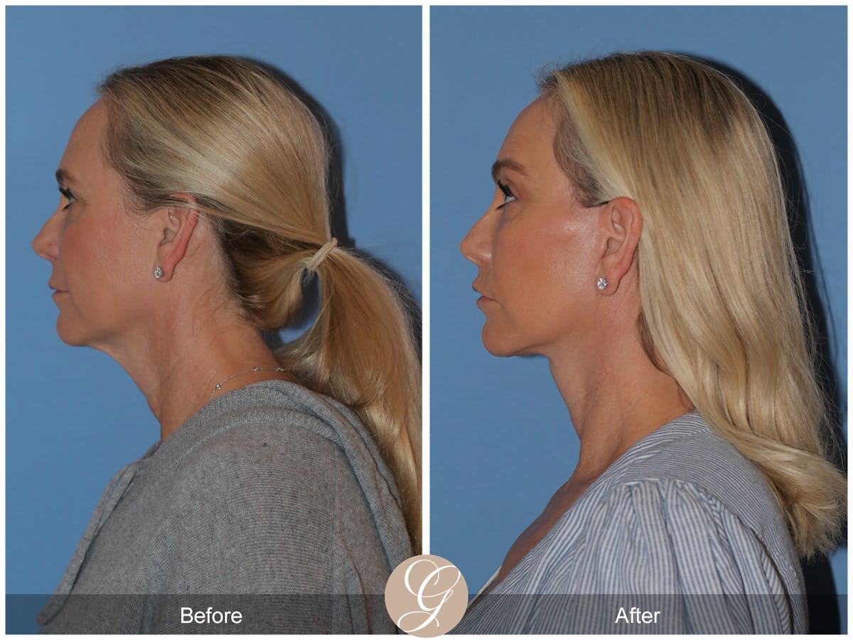 Preservation Facelift Before & After Gallery - Patient 136365 - Image 6