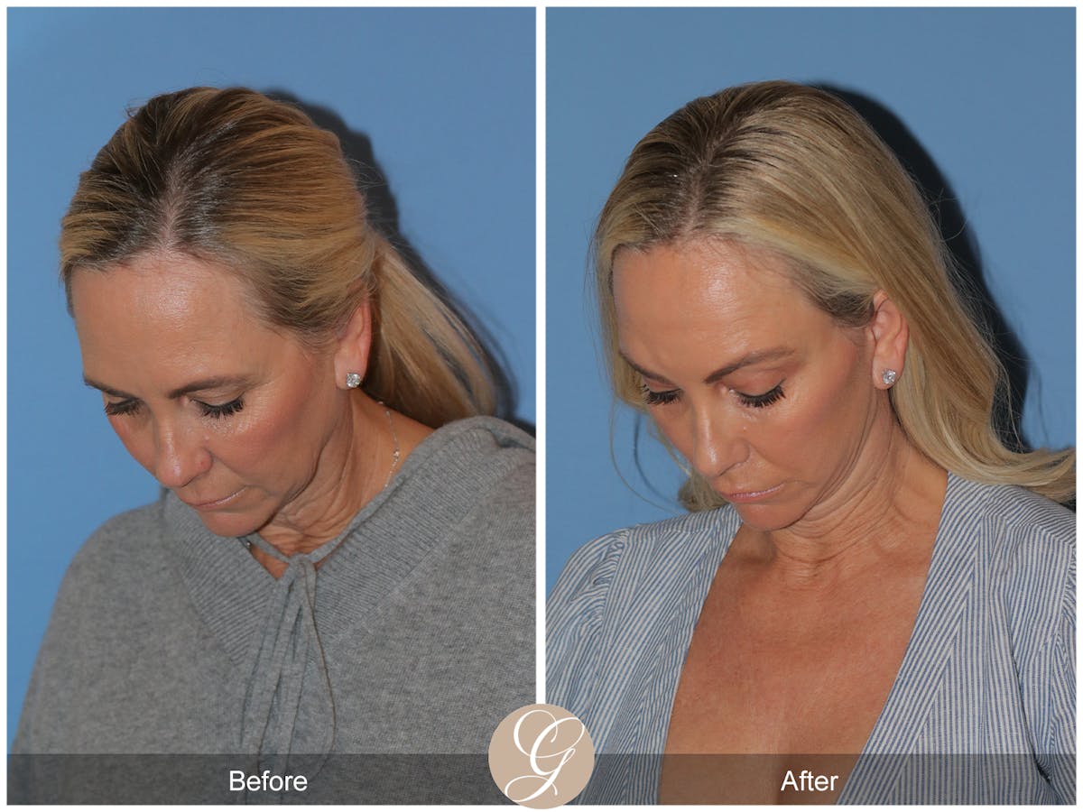Preservation Facelift Before & After Gallery - Patient 136365 - Image 7