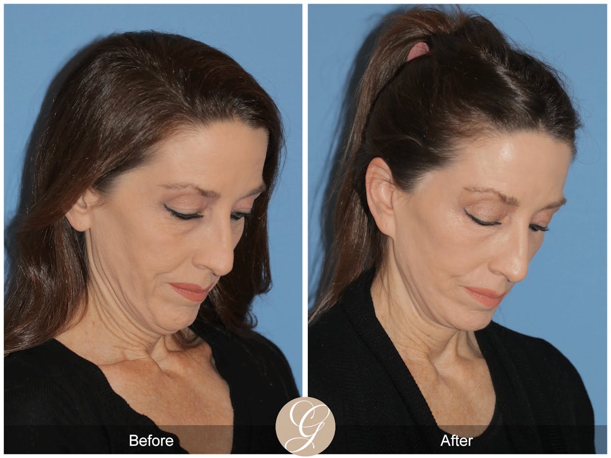 Preservation Facelift Before & After Gallery - Patient 170839 - Image 8