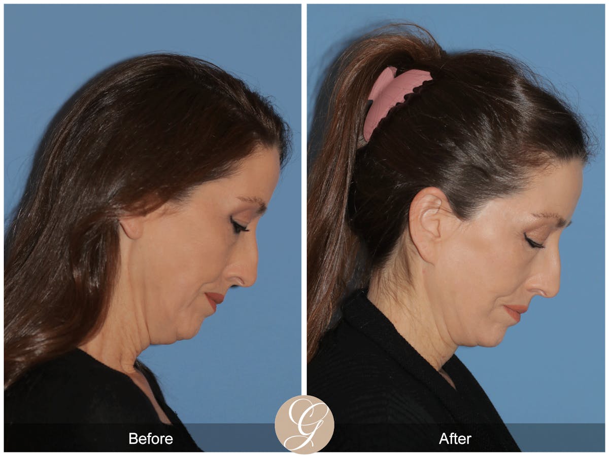 Preservation Facelift Before & After Gallery - Patient 170839 - Image 6
