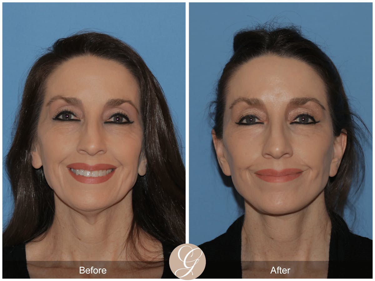 Preservation Facelift Before & After Gallery - Patient 170839 - Image 11