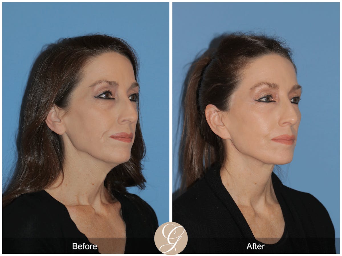 Preservation Facelift Before & After Gallery - Patient 170839 - Image 5