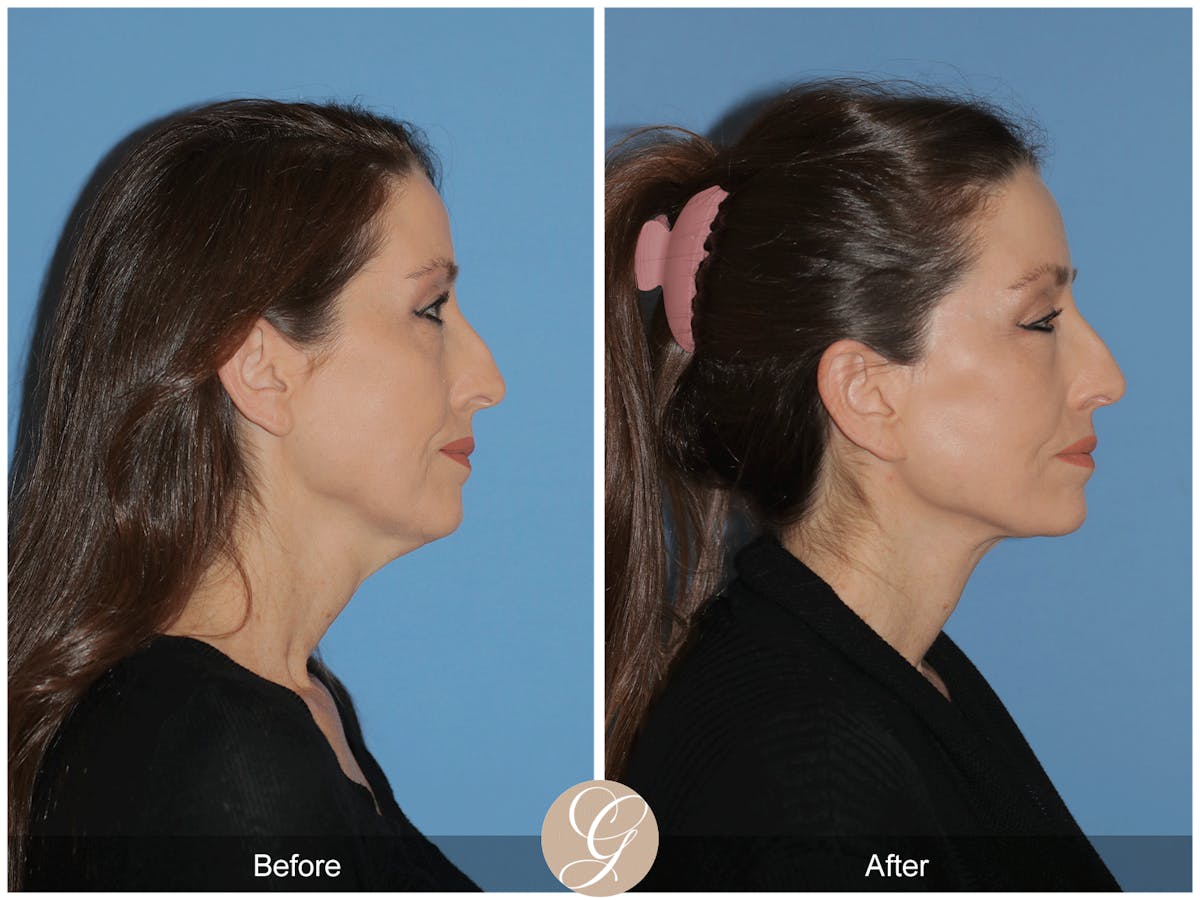 Preservation Facelift Before & After Gallery - Patient 170839 - Image 7