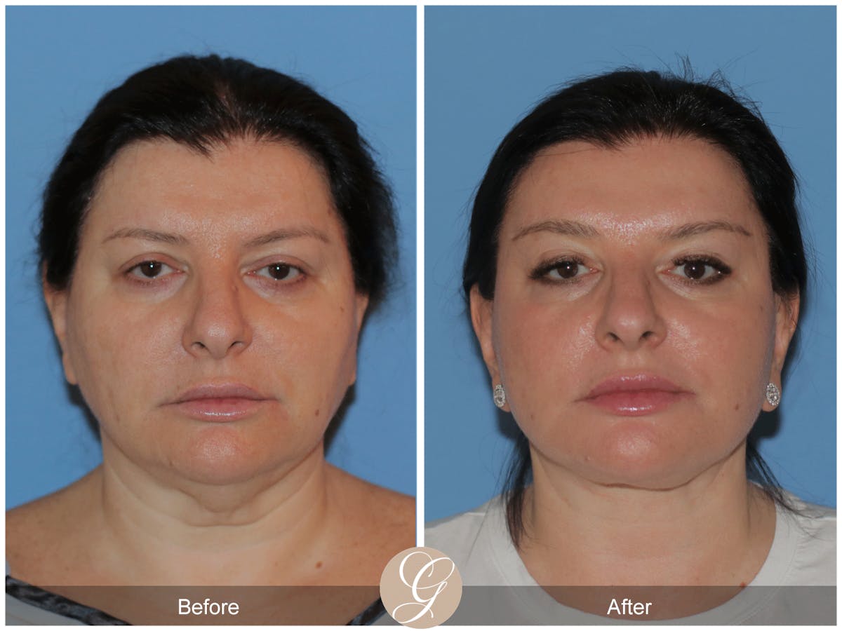 Preservation Facelift Before & After Gallery - Patient 323042 - Image 1