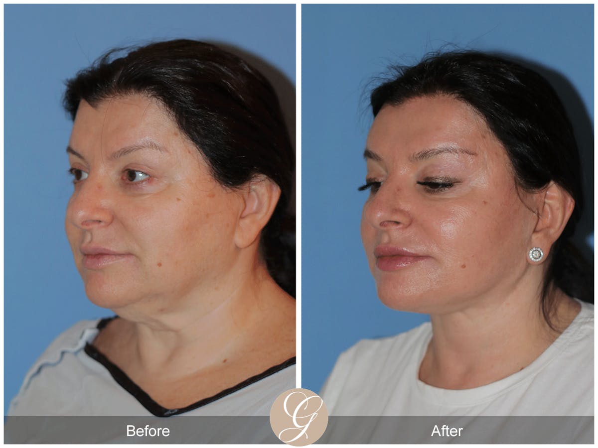 Preservation Facelift Before & After Gallery - Patient 323042 - Image 3