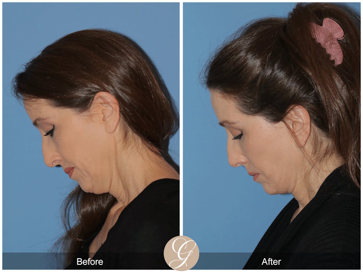 Preservation Facelift Before & After Gallery - Patient 170839 - Image 10