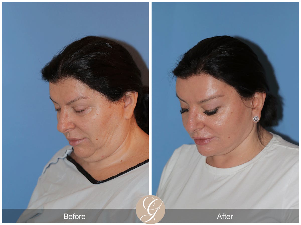 Preservation Facelift Before & After Gallery - Patient 323042 - Image 2