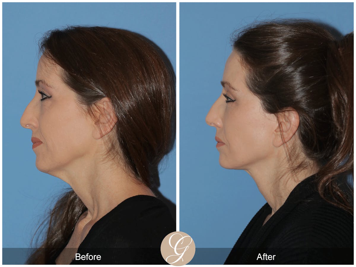 Preservation Facelift Before & After Gallery - Patient 170839 - Image 9