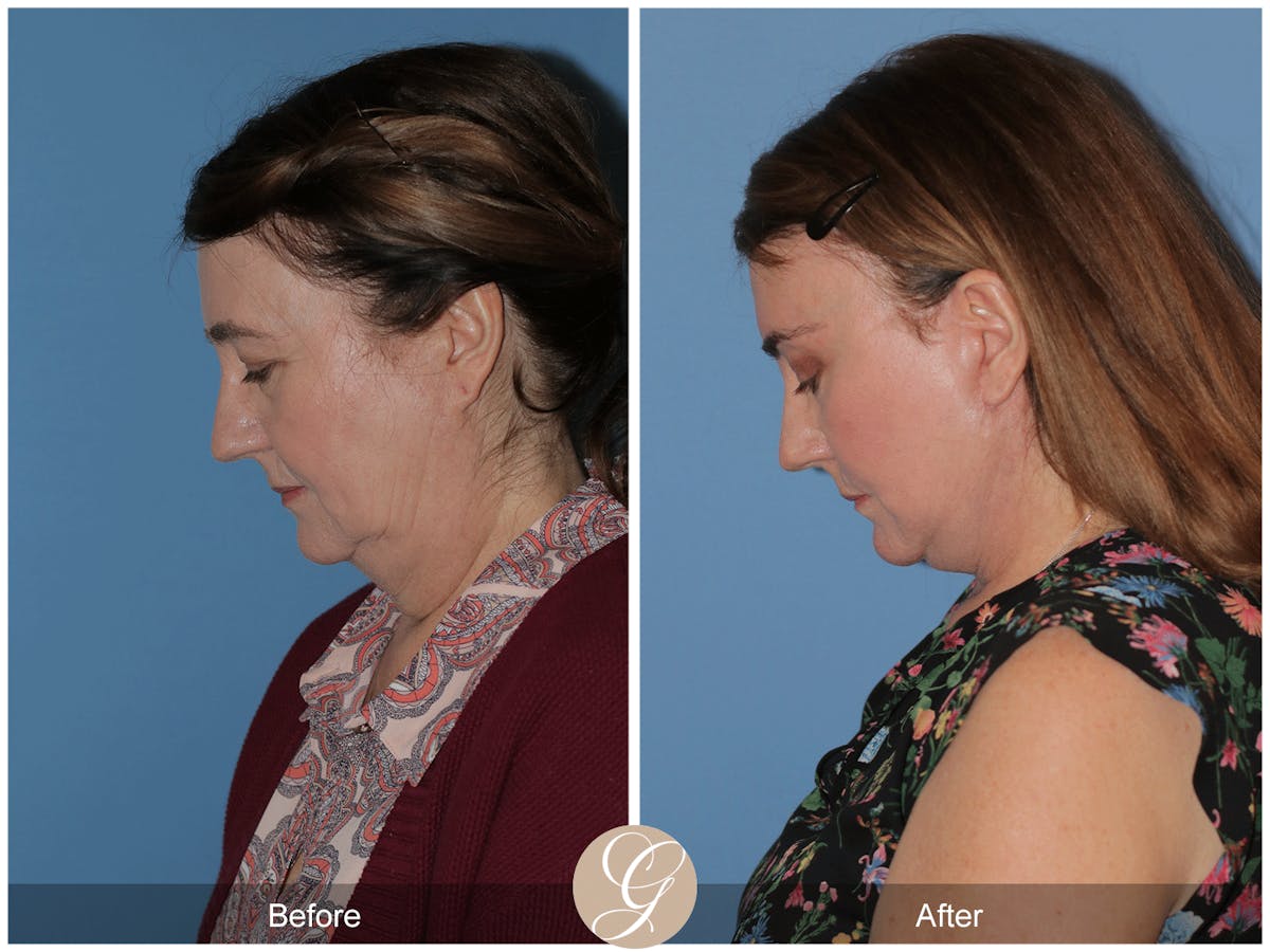 Preservation Facelift Before & After Gallery - Patient 134080 - Image 2