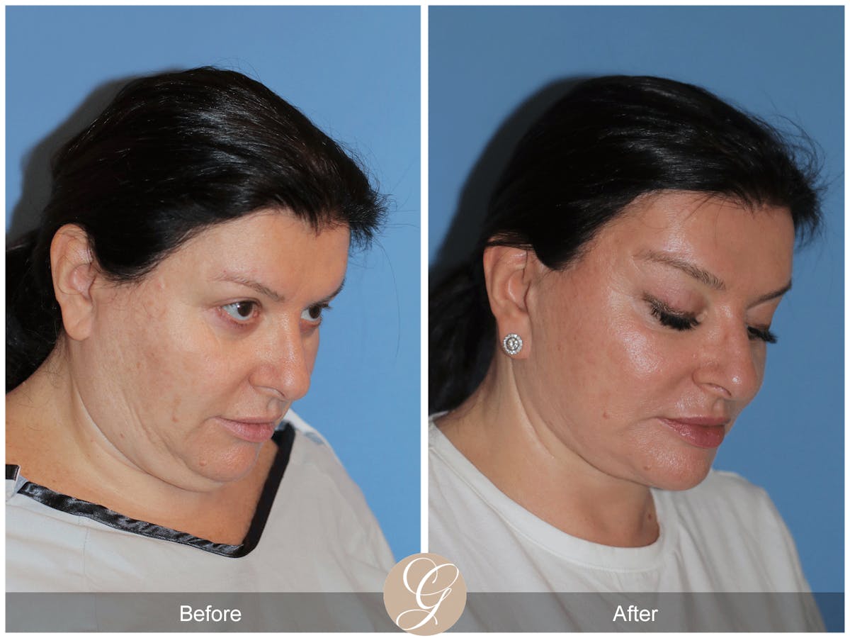 Preservation Facelift Before & After Gallery - Patient 323042 - Image 8