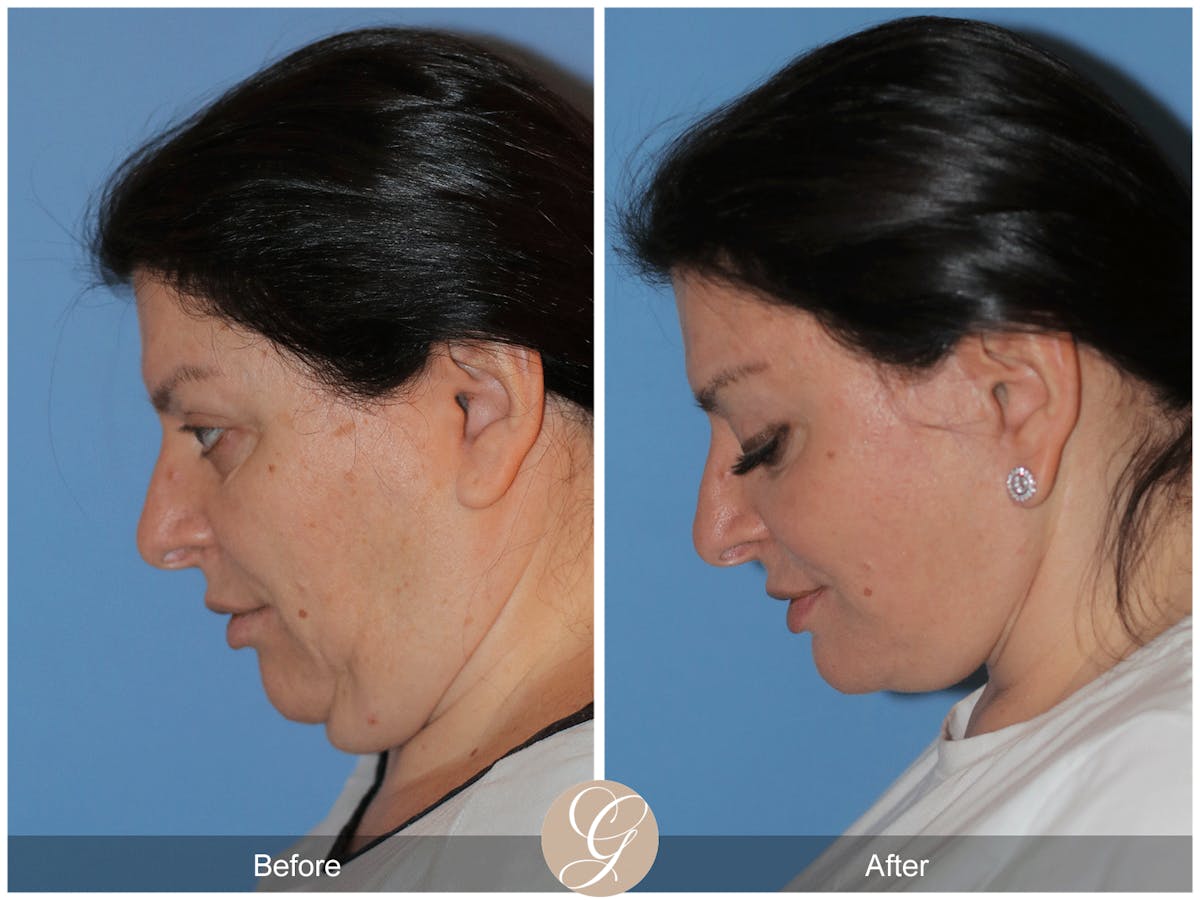 Preservation Facelift Before & After Gallery - Patient 323042 - Image 10