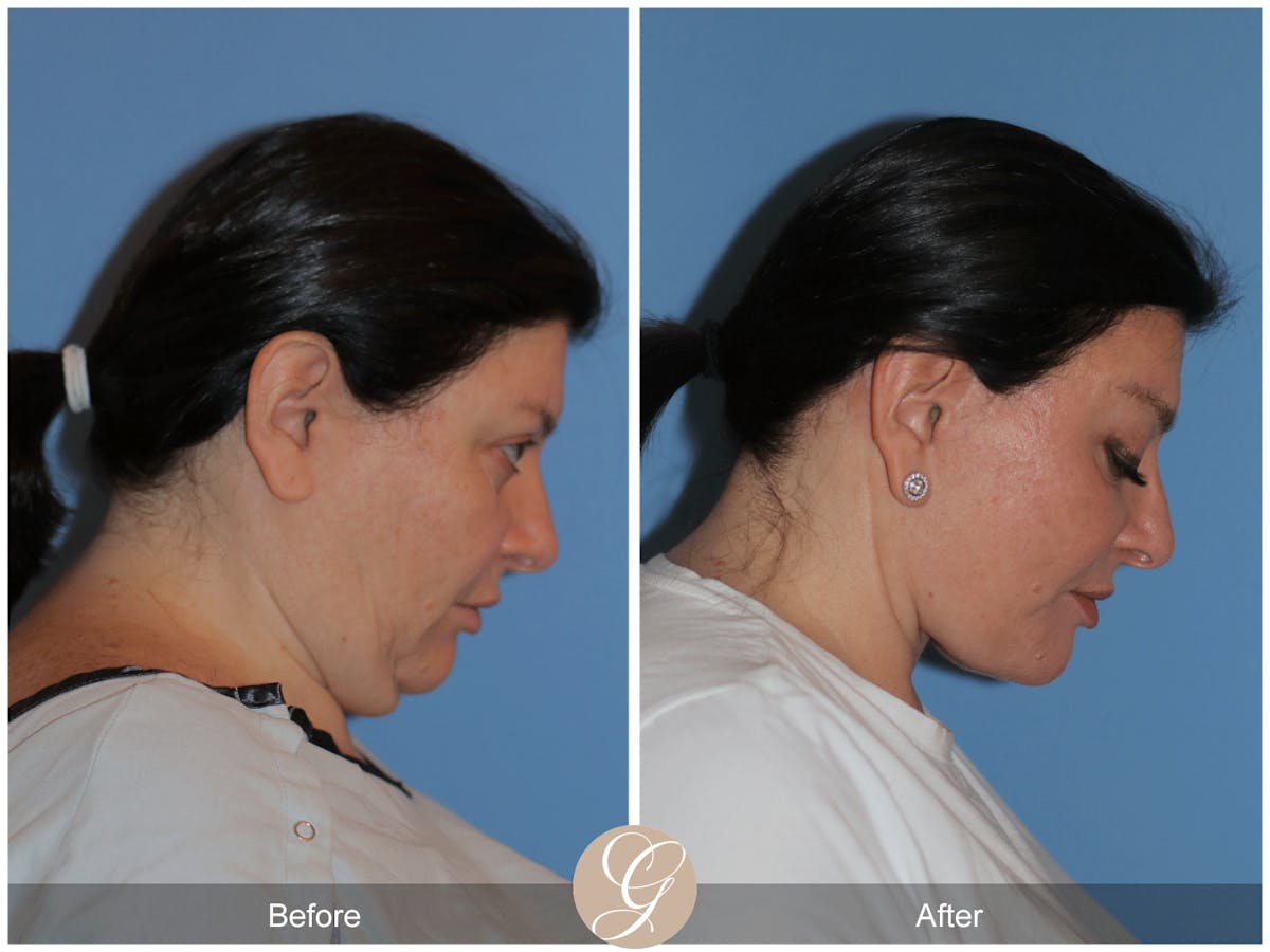 Preservation Facelift Before & After Gallery - Patient 323042 - Image 6