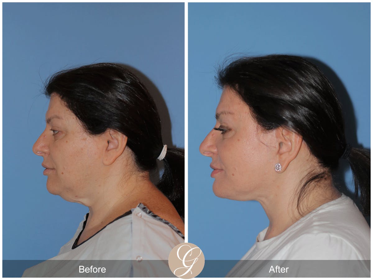 Preservation Facelift Before & After Gallery - Patient 323042 - Image 9