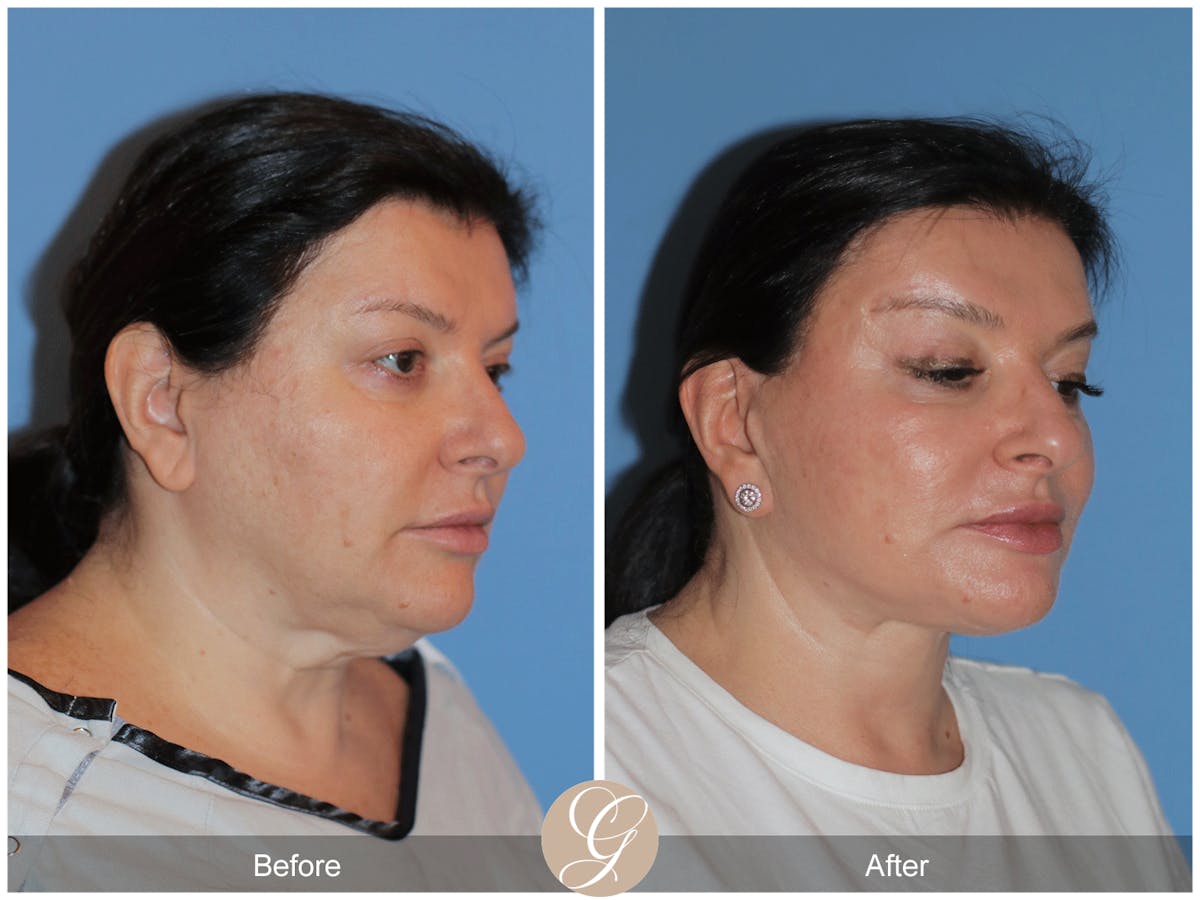 Preservation Facelift Before & After Gallery - Patient 323042 - Image 5