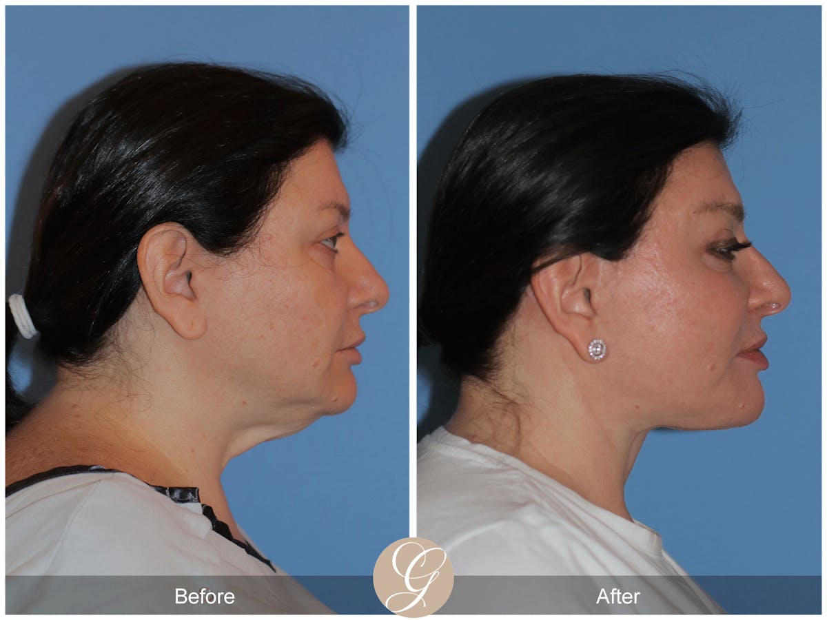 Preservation Facelift Before & After Gallery - Patient 323042 - Image 7