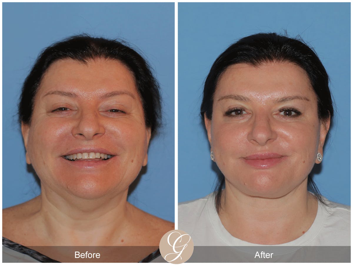 Preservation Facelift Before & After Gallery - Patient 323042 - Image 11