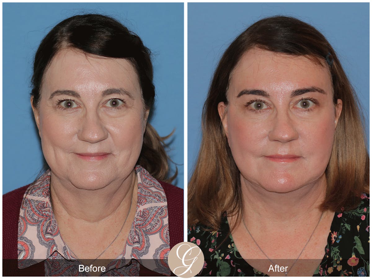 Preservation Facelift Before & After Gallery - Patient 134080 - Image 1