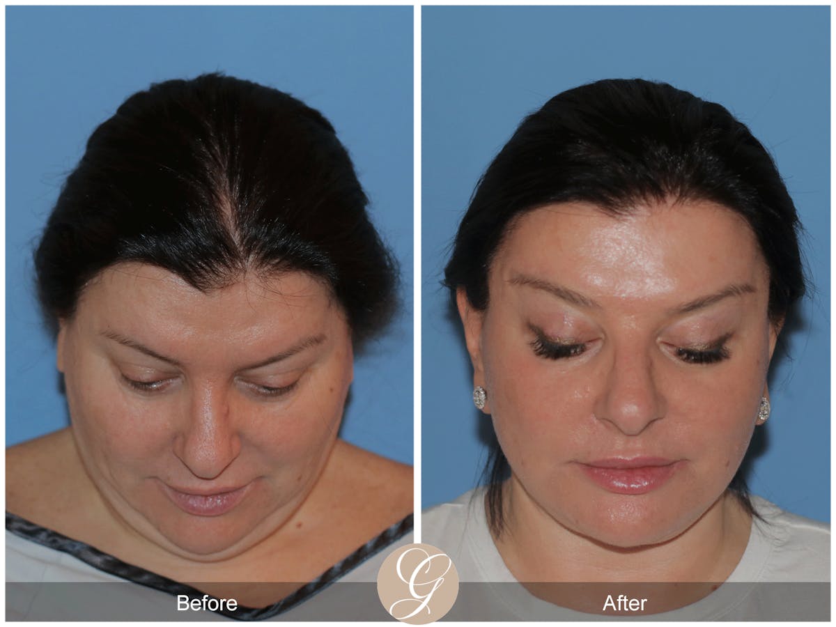 Preservation Facelift Before & After Gallery - Patient 323042 - Image 4