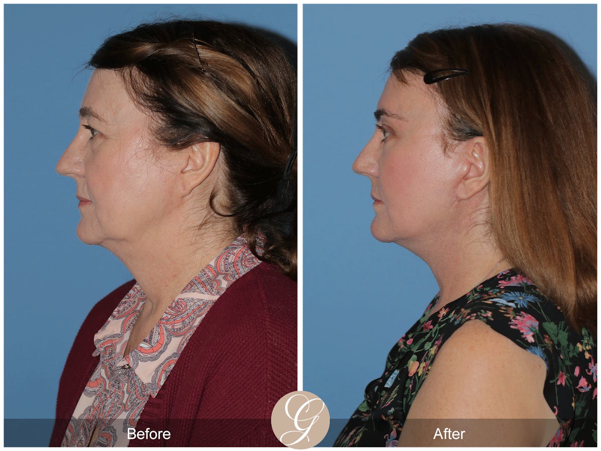 Preservation Facelift Before & After Gallery - Patient 134080 - Image 9