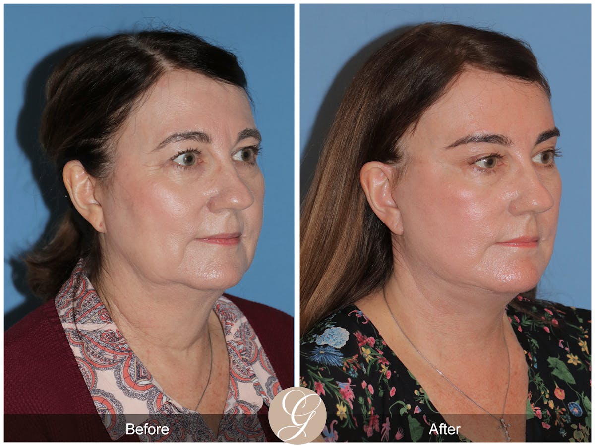 Preservation Facelift Before & After Gallery - Patient 134080 - Image 6