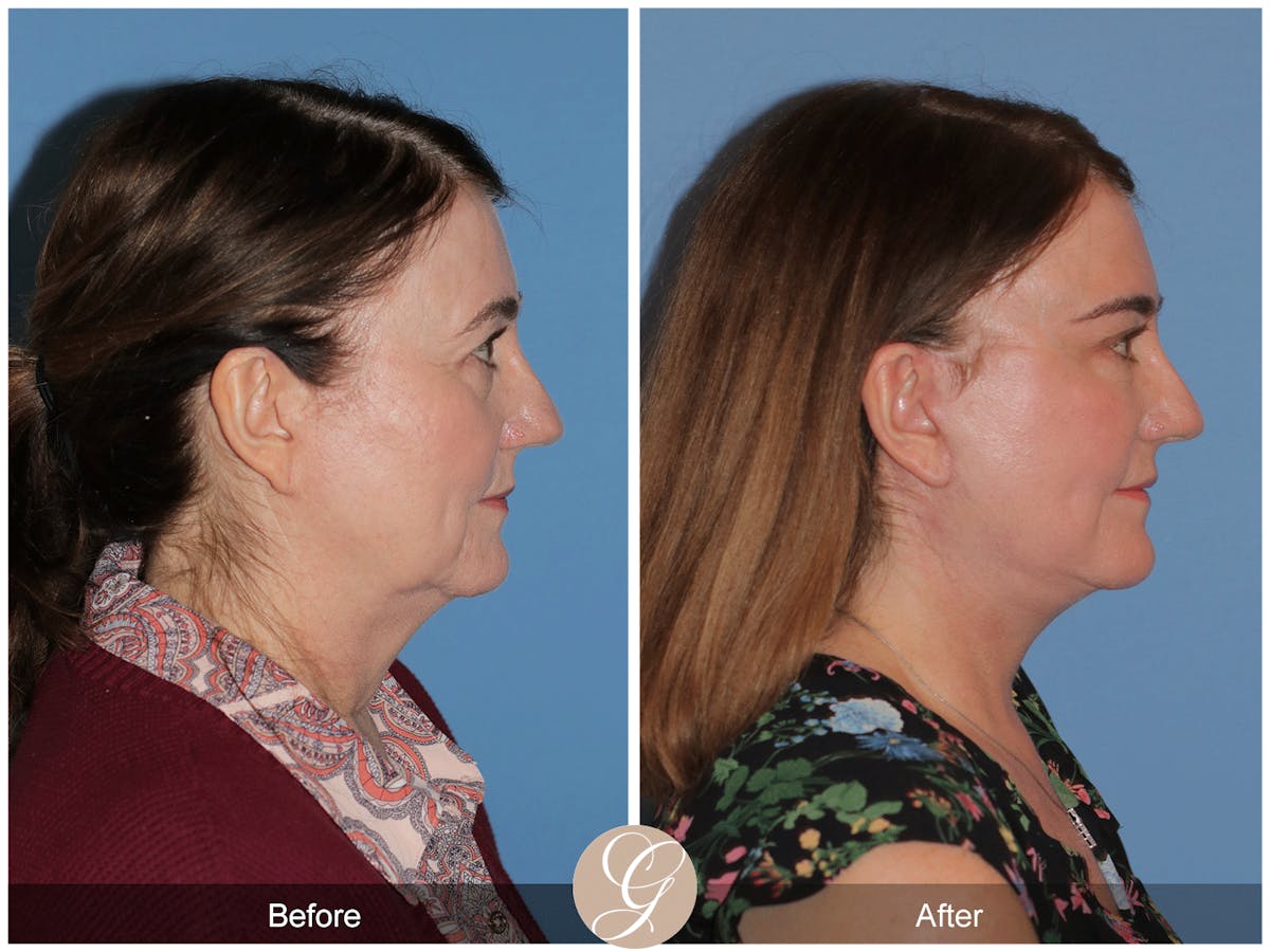 Preservation Facelift Before & After Gallery - Patient 134080 - Image 5