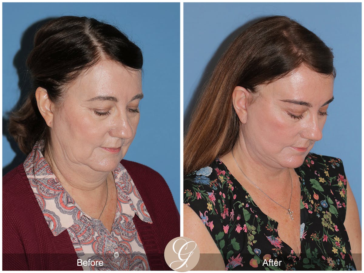 Preservation Facelift Before & After Gallery - Patient 134080 - Image 7