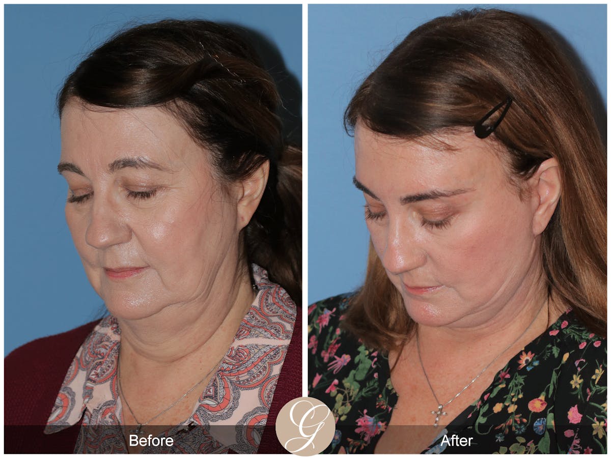 Preservation Facelift Before & After Gallery - Patient 134080 - Image 10