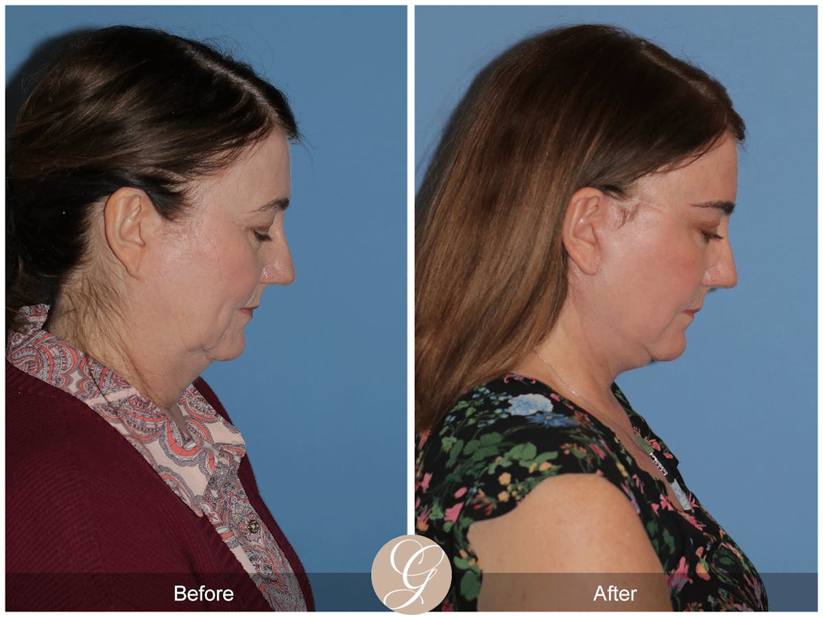 Preservation Facelift Before & After Gallery - Patient 134080 - Image 8