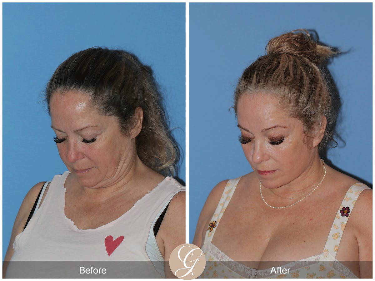 Deep Plane Facelift Before & After Gallery - Patient 226775 - Image 4