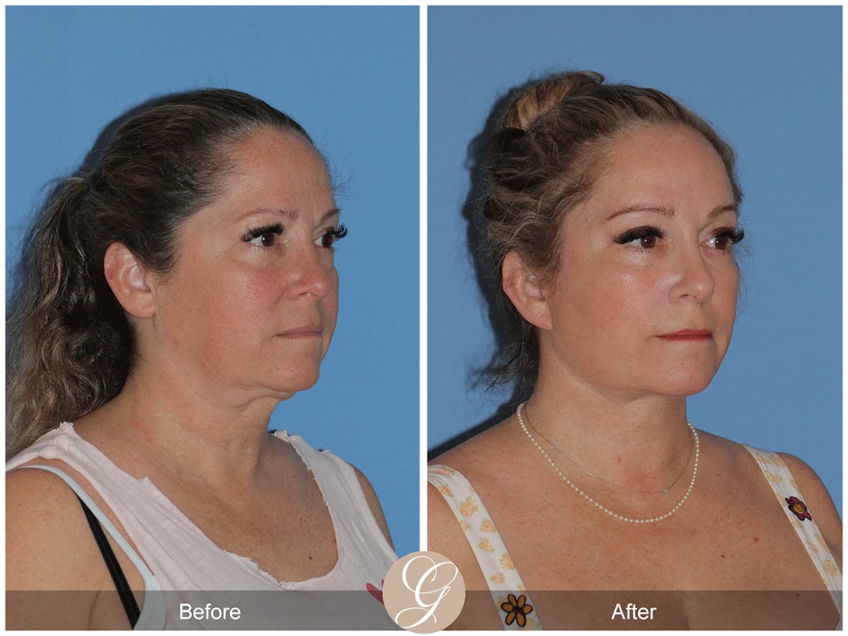 Deep Plane Facelift Before & After Gallery - Patient 226775 - Image 6