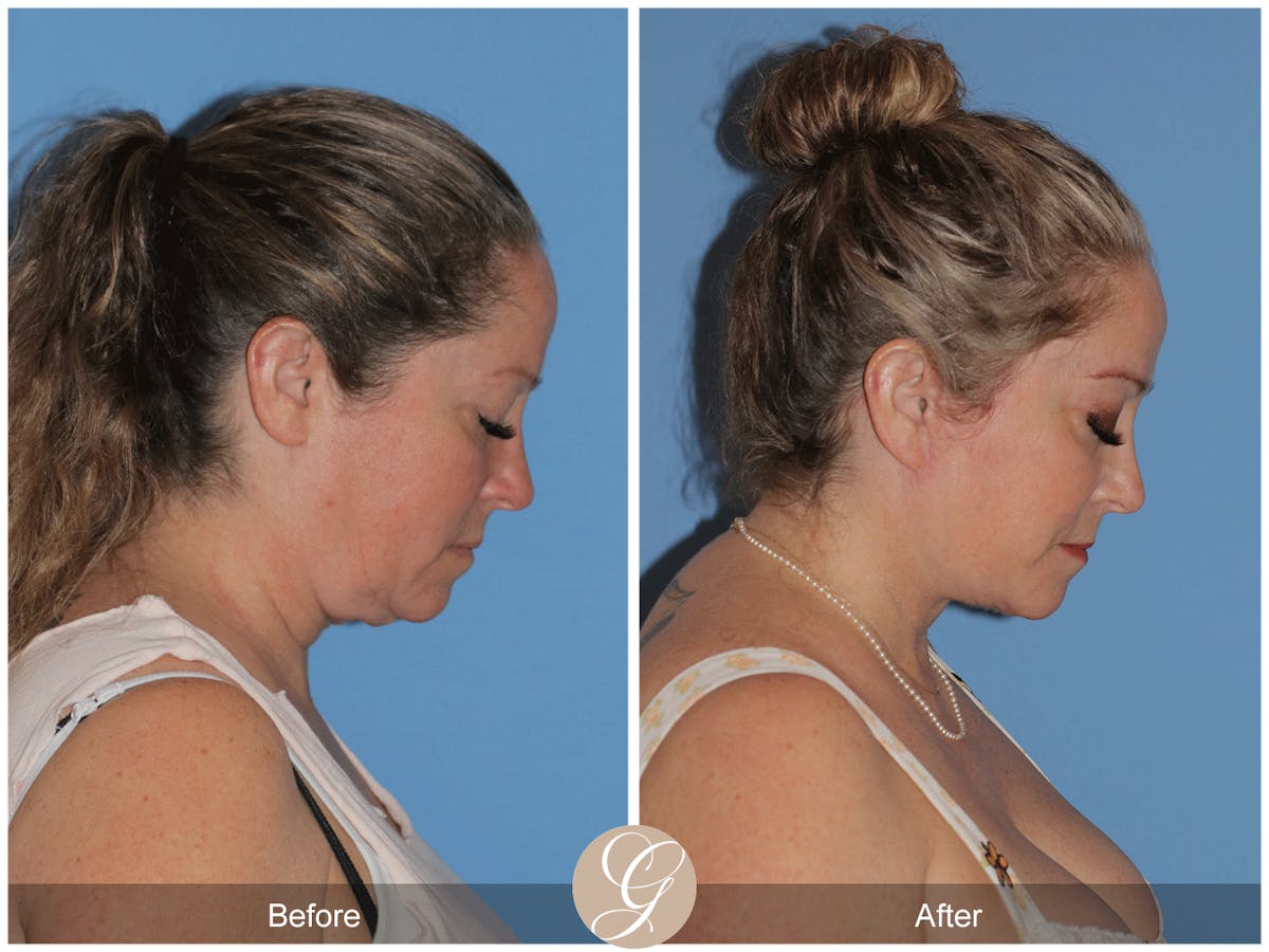 Deep Plane Facelift Before & After Gallery - Patient 226775 - Image 7